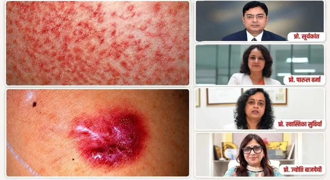 स्किन टीबी के मरीजों में बढ़ा डीआर-टीबी का खतरा